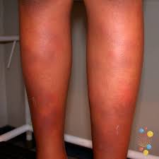 Image result for erythema nodosum
