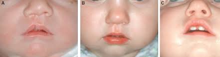Image result for Cleft Lip