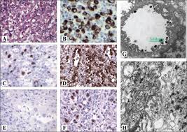 malignant mesothelioma is a primary cancer of the pleura, peritoneum and other mesothelial surfaces. Vitamin D Mediated Hypercalcemia And Cushing Syndrome As Manifestations Of Malignant Pleural Mesothelioma Endocrine Practice