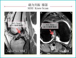 Jumping into Trouble – Knee Injuries | 聖德肋撒醫院-掃描部 ...