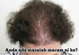 Rambut gugur selepas bersalin adalah perkara normal yang boleh terjadi berlanjutan selama beberapa bulan. Pin Auf Pelebat Rambut Paling Berkesan