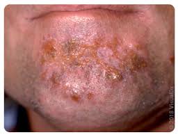 Image result for red rash face