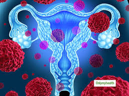 Vaginal bleeding—sometimes cervical cancer mimics menstrual bleeding. Stages Of Cervical Cancer Symptoms Identification And Preventive Methods