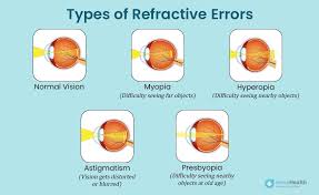Image result for Refractive Error