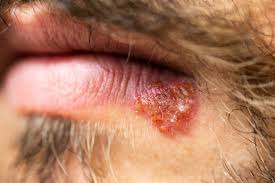 Cold Sores and HIV: Is There a Link?
