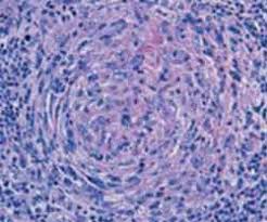 Dirk m elston, md more. Managing Angioimmunoblastic T Cell Lymphoma