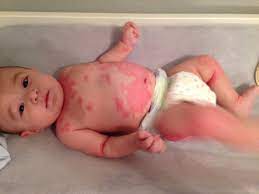 Ia dikenali juga sebagai atopic dermatitis (kulit). Cara Merawat Penyakit Kulit Ekzema Dan Psoriasis Pada Bayi Hi Meed Di Sini