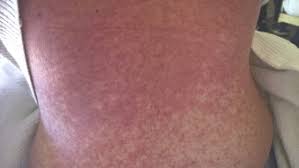 Image result for Generalized Rash