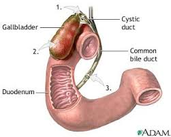 Gallstones are pieces of solid material that form in your gallbladder, a small organ under your liver. Mbbs Um Malaya Extenders Surgery Biliary Tract