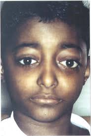 Orbital involvement in sickle cell disease: a report of five cases and  review literature