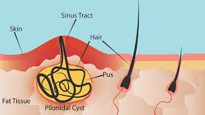 I can't believe there are people out there who leave these things alone. What Is Pilonidal Cyst Symptoms Causes Diagnosis Treatment And Prevention Everyday Health