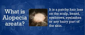 While there are many claims when it comes to treating hypothyroidism, the best option remains that of homeopathy. Alopecia Areata Hairless Patches Homeopathic Treatment I Types Symptoms And Diagnosis