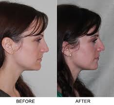 Here goes the painful process for 10 minutes at least. Nasal Polyps Dr Garrett Bennett Ny Sinus Rhinoplasty Surgeon