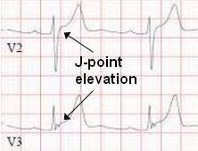 Image result for Early Repolarization