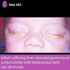 Image result for Gonococcal Conjunctivitis