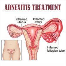 Adnexitis is a gynaecological infection affecting women only. Adnexitis Non Invasive Diagnose Correct In Mumbai A Swelling Of The Ovaries Or Fallopian Tubes At Mehak Wellness Centre We Diagnose And Correct For Adnexitis This Is Done Through Computerized