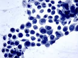 Examples of symptoms that are associated with cervical cancer include: Colposcopy Digital Atlas