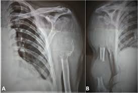 The international myeloma foundation can provide further support for myeloma patients. Multiple Myeloma Mimicking Primary Bone Tumour Bmj Case Reports