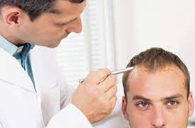 Hair texture is determined by multiple genes and alleles that differ among world populations. Genetic Hair Loss Male Pattern Baldness Toppikmalaysia