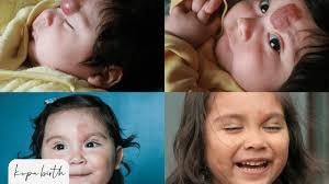 Baby Birthmarks (With Pictures Included) • Kopa Birth®