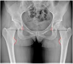 Image result for Functional Leg Length Discrepancy