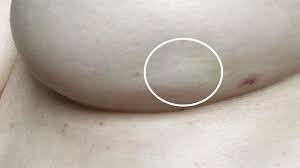 Learn to watch and feel for them to catch the cancer in its early stages research has found that this may be an early warning sign of breast cancer, sometimes noticeable even before you actually find a mass you can detect. Breast Cancer Symptoms What A Breast Dimple Looks Like