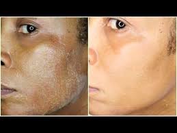 Natural Chemical Peel At Home Remove Acne Wrinkles Dark Spots Blemishes Chemical Peel Chemical Peel At Home Natural Aging Skin Care