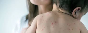 Image result for Varicella zoster on human skin