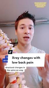 X-ray Changes in the Spine: What You Should Know