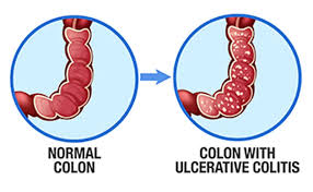Image result for Ulcerative Colitis