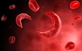 Emdocs Net Emergency Medicine Educationthe Sickle Cell Patient Ed Management Of Acute Complications Emdocs Net Emergency Medicine Education