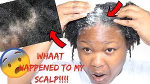 Limit the use of butters, creams or products with silicones. How To Remove Product Build Up On My Natural Hair How I Got Rid Of My Eczema Itchy Flaky Scalp Youtube