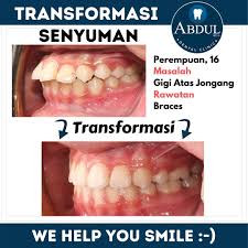Gigi yang patah atau gompal akibat kecelakaan atau sebab lain biasanya rentan terjadi pembusukan,untuk menghindari pembusukan harus segera dibawa ke dokter. Rawatan Veneer Untuk Gigi Jongang