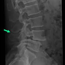 Images showing anterolisthesis in various grade level. Kissing Spine Syndrome An Often Underdiagnosed Cause Of Back Pain Eurorad