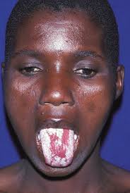 Stevens-johnson Syndrome #1 Photograph by Science Photo Library