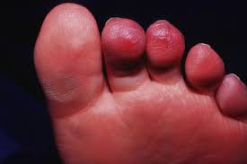 Image result for Chilblains