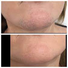 Contact tattoo free laser removal on messenger. Erase Aesthetics Tattoo Removal Middlesbrough Thread Vein Removal Middlesbrough