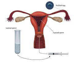 Artificial Insemination Englewood Co Denver Co Denver Fertility Albrecht Women S Care