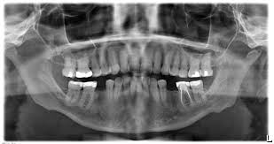 Image result for Alveolitis sicca)