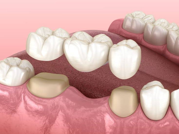 Dental Bridges product image