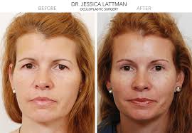 Eyelid droop is a common issue among aging men and women, many of whom opt for cosmetic surgery to correct the problem. Endoscopic Browlift Expert Nyc Droopy Eyebrows New York And Manhattan Nyc