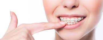 Most will recommend you wear your retainer full time for the. Can I Have My Braces Off Earlier Than Expected Weber Orthodontics
