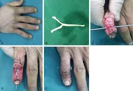Abstract the operative treatment of mallet fractures of more than one third of the articular surface is controversial. Treatment Of Mallet Finger Deformity With A Modified Palmaris Longus Tendon Graft Through A Bone Tunnel Abstract Europe Pmc
