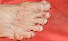 Image result for gout symptoms toe
