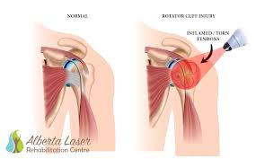 Supraspinatus tendonitis is a common shoulder problem affecting 1 in 5 adults. Case Study Supraspinatus Tendon Tear