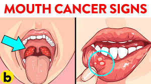 Bleeding or numbness in the mouth. 6 Early Signs Of Mouth Cancer You Should Not Ignore Youtube