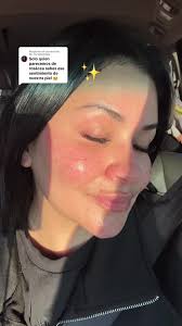 Cómo manejar la rosácea en tu rostro