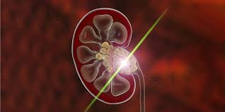 Best Kidney Stone Treatment In Hyderabad Pristyn Care