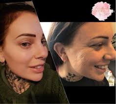 Melody has been coming to me for 2 years now ❤️ She sent me these photos  over to show the difference since we started her treatments, and with her  consent she has