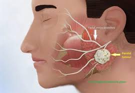 Head and neck cancer surgery